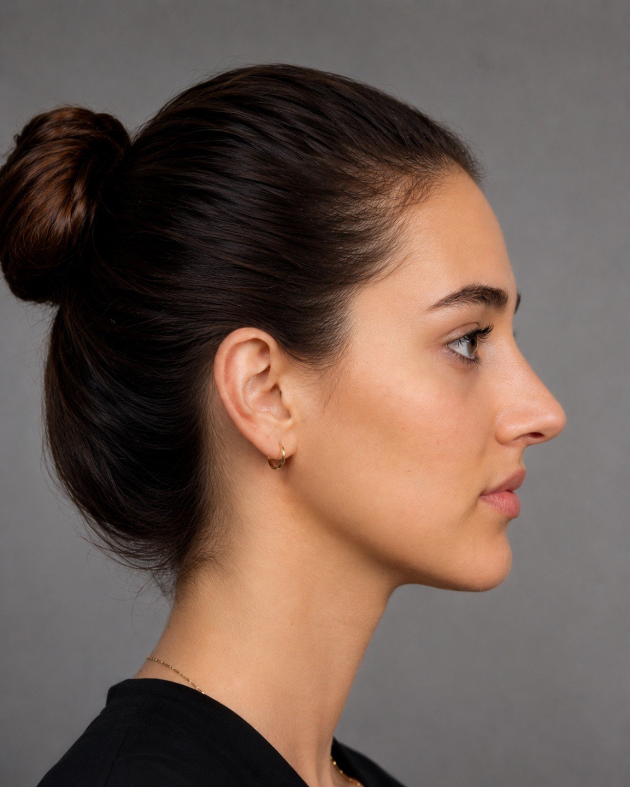 Rhinoplasty after